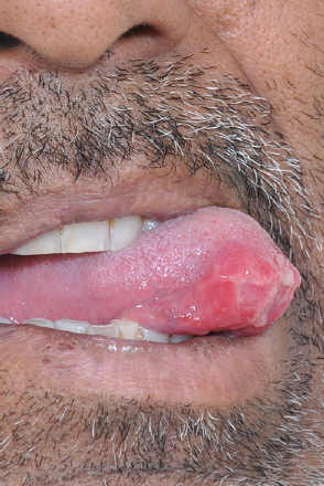 Tuberculosis of the tongue: A rare presentation of common disease
